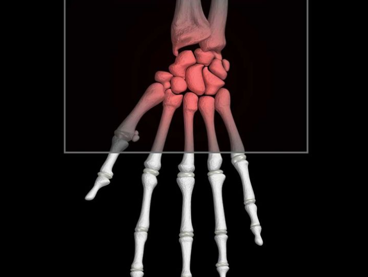 arthritis